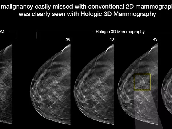 3D mammography: Now in Onalaska - Gundersen Health System